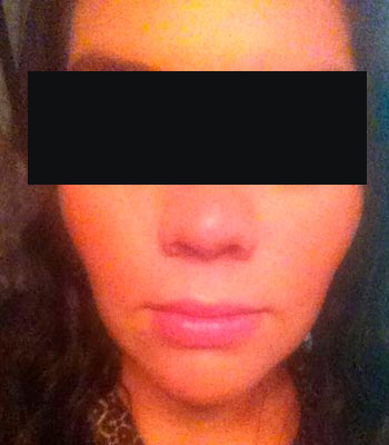 Trauma Facial