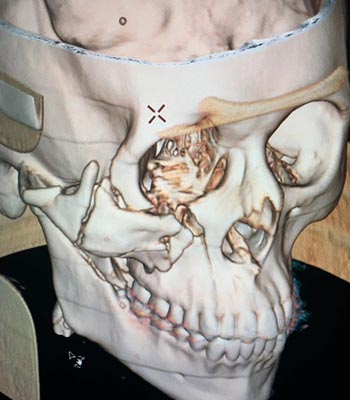 Trauma facial