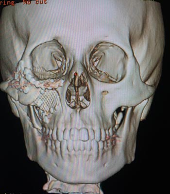 Trauma facial