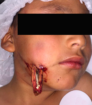 Trauma Facial