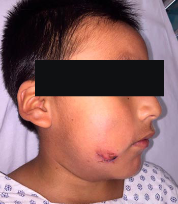 Trauma Facial
