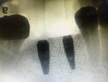 Trauma Facial