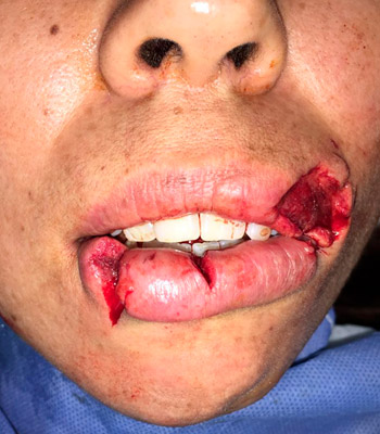 Trauma Facial