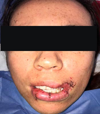 Trauma Facial