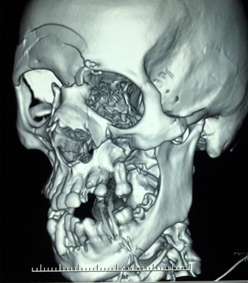 Trauma Facial