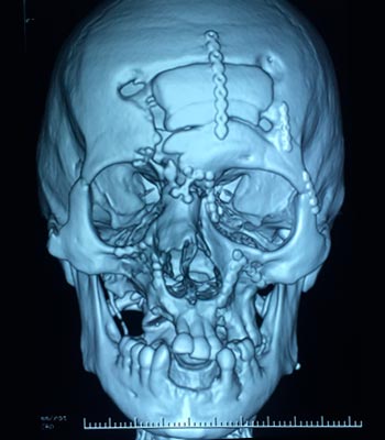 Trauma Facial