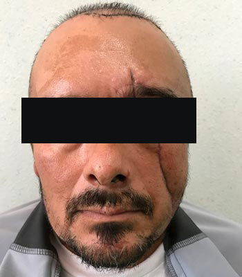 Trauma Facial