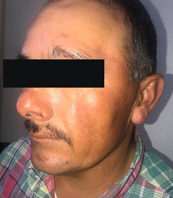 Trauma Facial