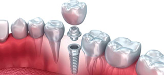 ¿Qué son los implantes dentales?