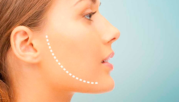 ¿Por qué hacerse una mentoplastia?