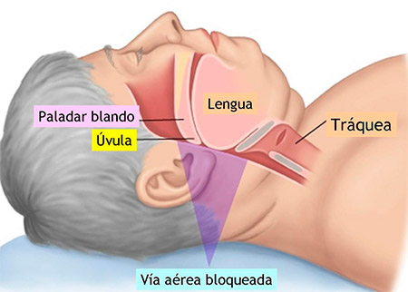Apnea del sue&ntilde;o