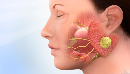 Causas de Tumor de gl&aacute;ndulas salivales 