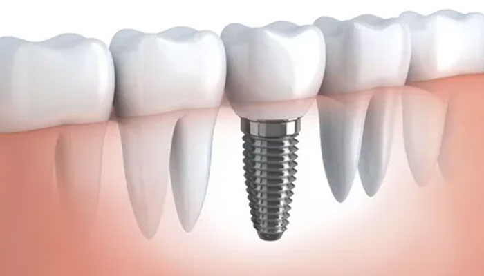 Implantes dentales