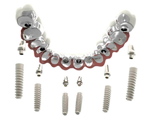 &iquest;Qu&eacute; son los implantes dentales?