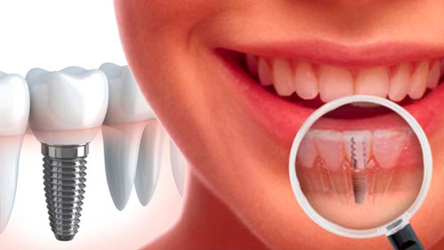 &iquest;Cu&aacute;nto cuestan los implantes dentales?