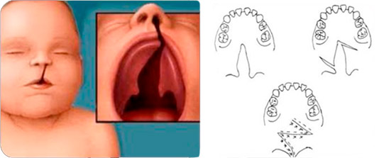Queiloplastia y Palatoplastia