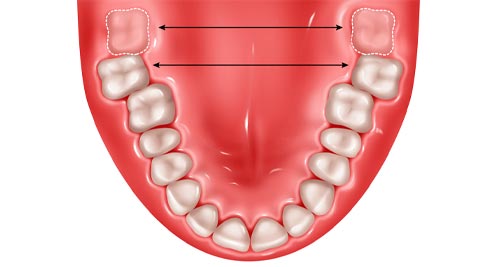 Malposiciones Dentarias