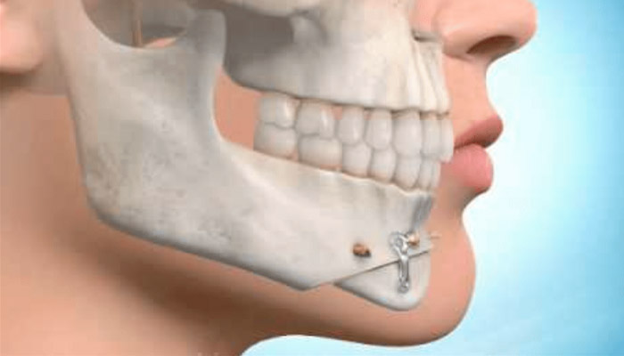 Mentoplastia