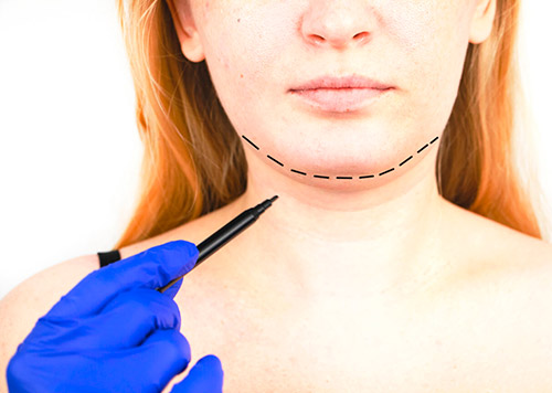 &iquest;Por qu&eacute; hacerse una mentoplastia?